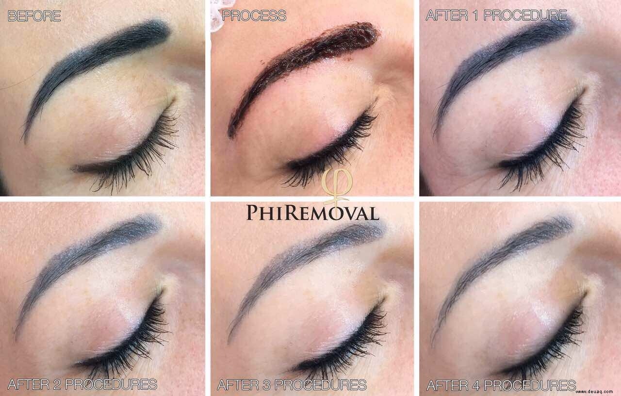 Wie man dauerhafte Kosmetik entfernt (einschließlich schlechtem Microblading) 