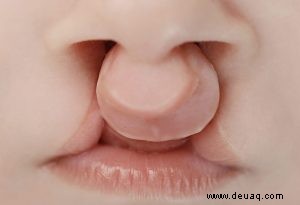 Lippen- und Gaumenspalten bei Babys 