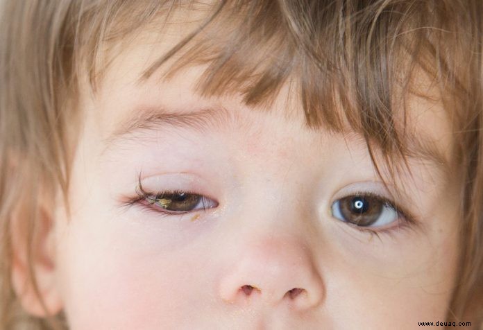 Konjunktivitis (Pink Eye) bei Babys und Kindern 