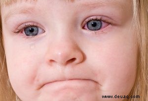 Konjunktivitis (Pink Eye) bei Babys und Kindern 