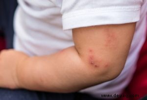 Virusfieber bei Kindern – Symptome, Ursachen und Behandlung 