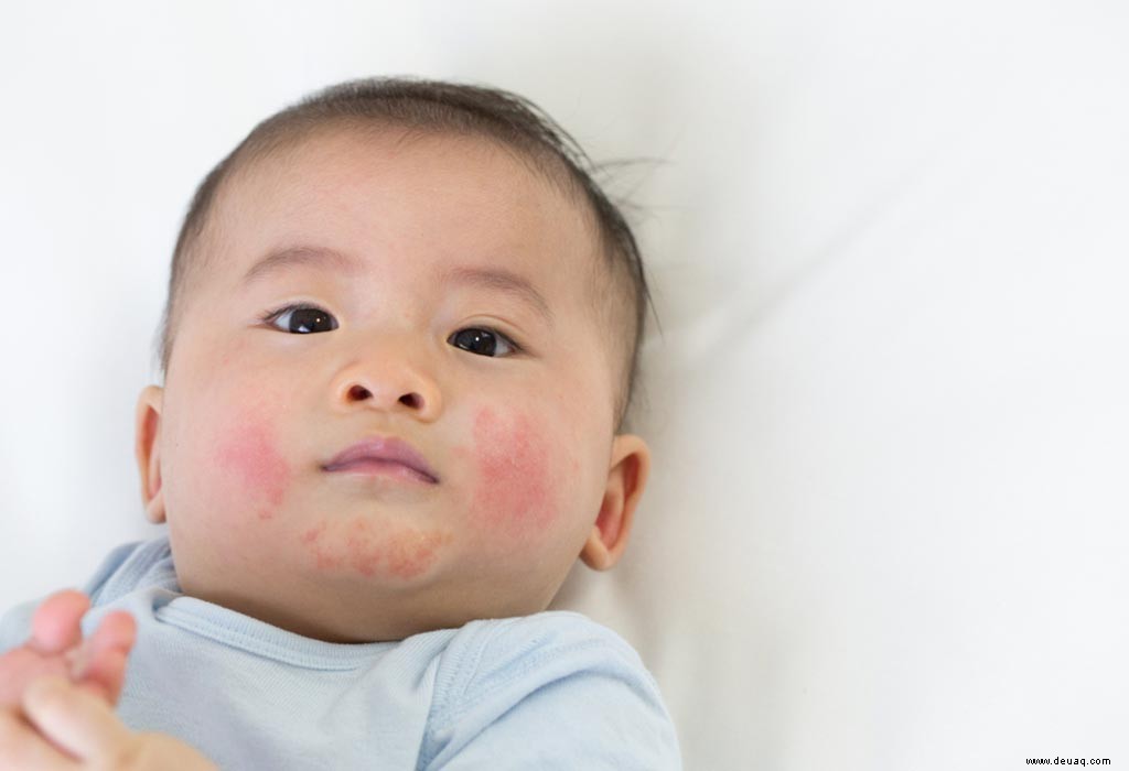 Nesselsucht bei Babys – Ursachen, Symptome und Behandlung 