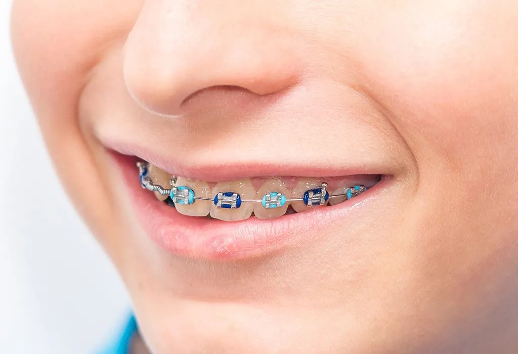 Zahnspangen für Kinder – Arten, Pflegetipps und Kosten 
