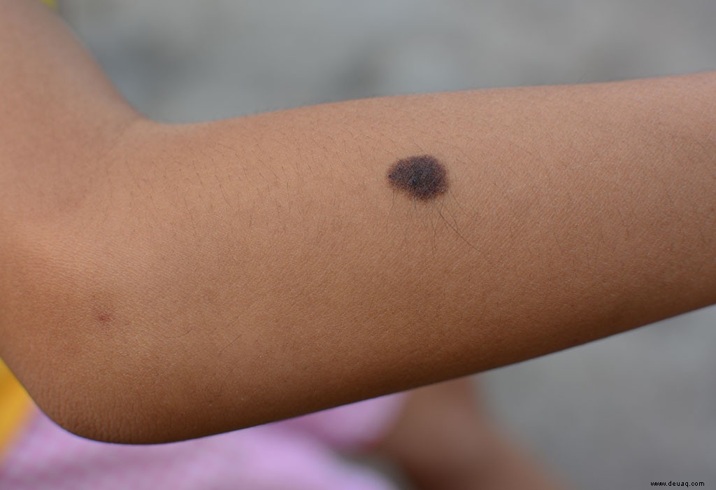 Maulwürfe bei Kindern – Symptome und Vorbeugung 