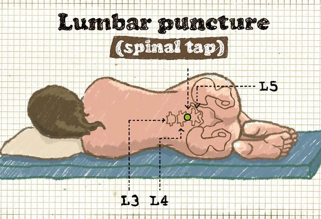 Lumbalpunktion (Spinalpunktion) bei Kindern 