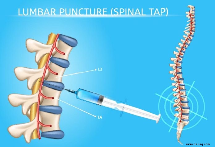 Lumbalpunktion (Spinalpunktion) bei Kindern 