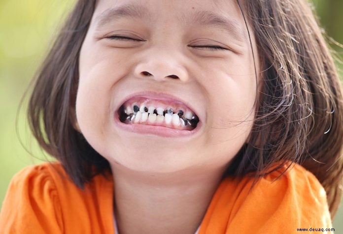 Gebrochene Zähne bei Kindern – Ursachen, Behandlung und Vorbeugung 