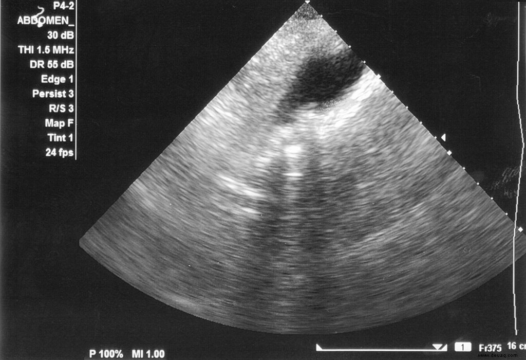 Gallensteine ​​(Cholelithiasis) bei Kindern 