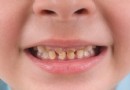 Gelbe und andere Verfärbungen der Zähne bei Kindern 