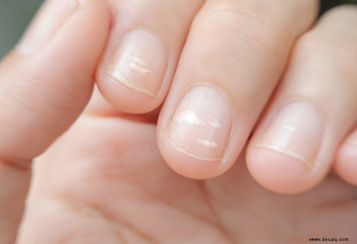 Weiße Flecken auf den Nägeln Ihres Kindes – sollten Sie sich Sorgen machen 