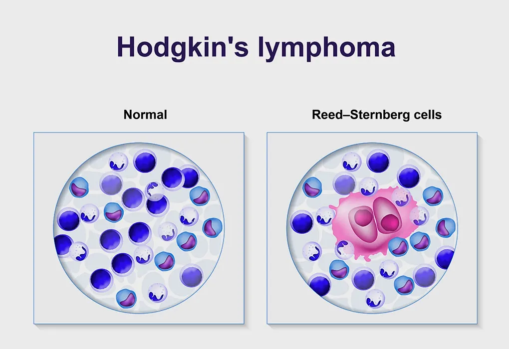 Lymphom bei Kindern – Ursachen, Diagnose und Behandlung 