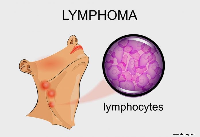 Lymphom bei Kindern – Ursachen, Diagnose und Behandlung 
