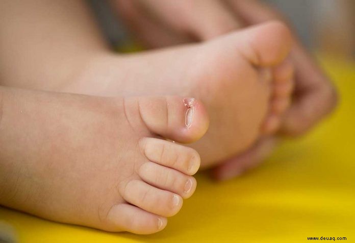Eingewachsener Zehennagel bei Kindern – Ursachen, Symptome &Abhilfe 