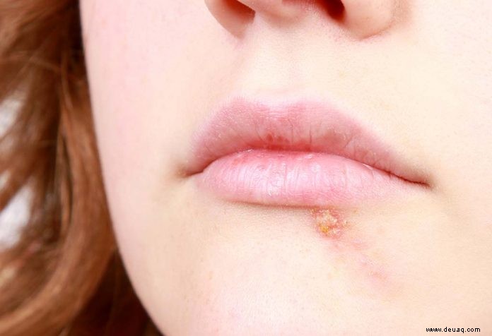 Lippenherpes (Herpes-simplex-Virus) bei Kindern 