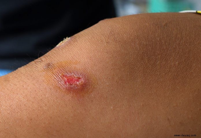 Impetigo bei Kindern 