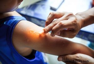 Impetigo bei Kindern 