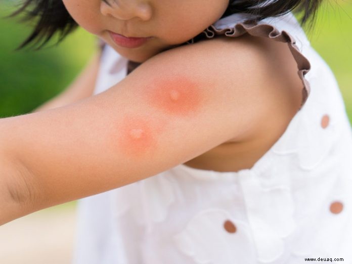 Dengue bei Kindern – Anzeichen, Diagnose und Behandlung 