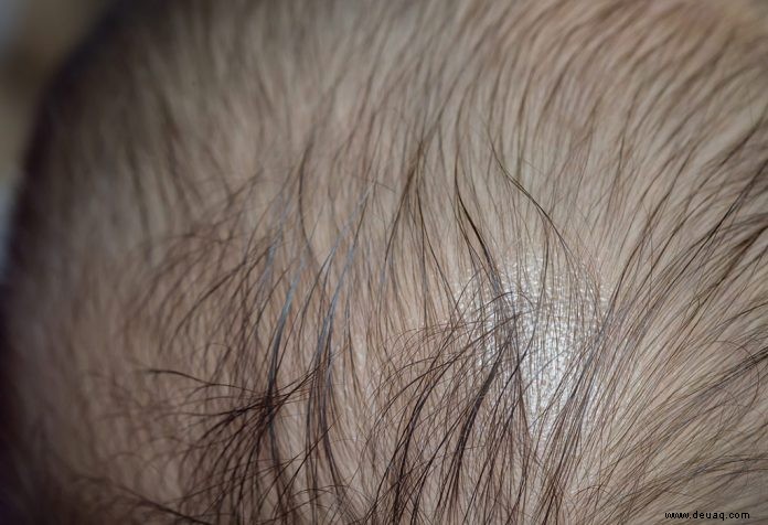 Alopecia Areata bei Kindern 