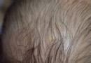 Alopecia Areata bei Kindern 