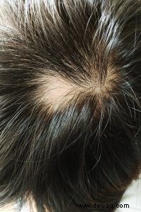 Alopecia Areata bei Kindern 