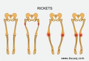 Rachitis bei Kindern 