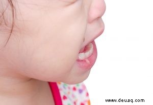 Mundgeschwüre (Krebsgeschwüre) bei Babys und Kindern 
