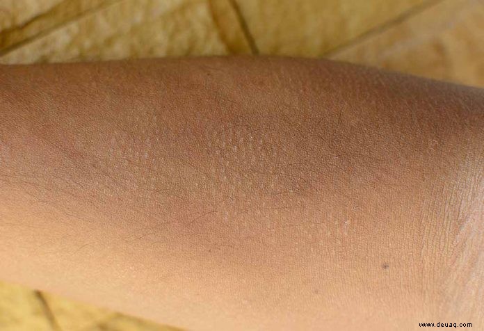 Symptome und Behandlung von Keratosis Pilaris bei Kindern 