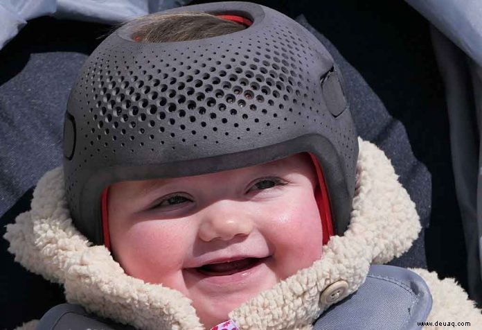 Warum müssen manche Babys einen Helm tragen? 