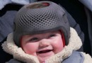 Warum müssen manche Babys einen Helm tragen? 