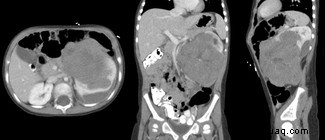 Mit dem Wilms-Tumor verbundenes Gen gibt Kindern mit seltenem Nierenkrebs Hoffnung 