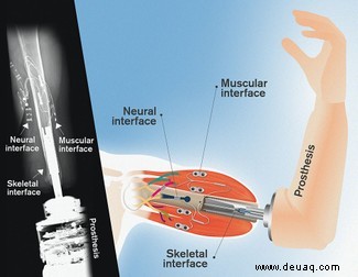 Gedankengesteuerter bionischer Arm mit Tastsinn „könnte in zwei Jahren erhältlich sein“ 
