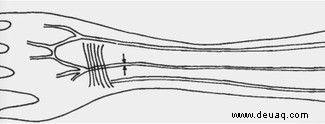 Menschen entwickeln eine zusätzliche Arterie im Arm 