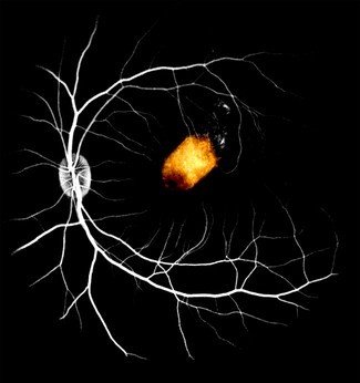 Transplantationen von Netzhautzellen könnten Blindheit behandeln 