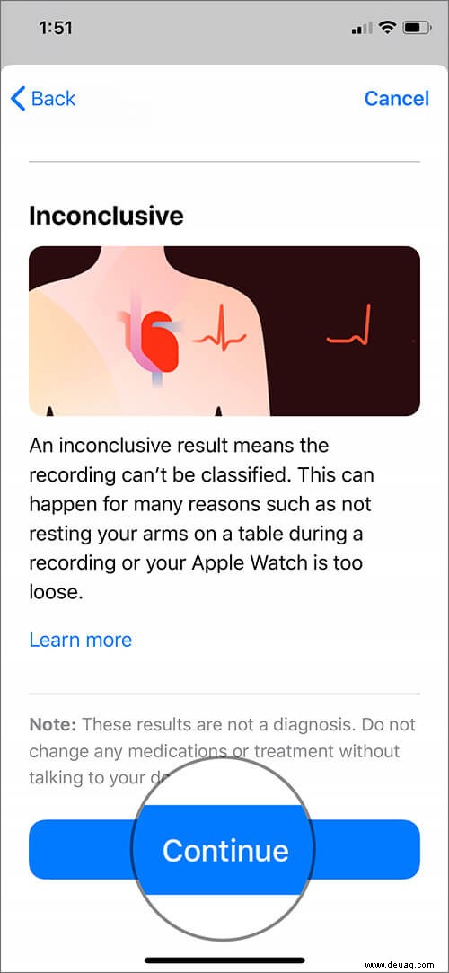 Einrichten und Verwenden von EKG auf der Apple Watch (Serie 4 oder 5) 