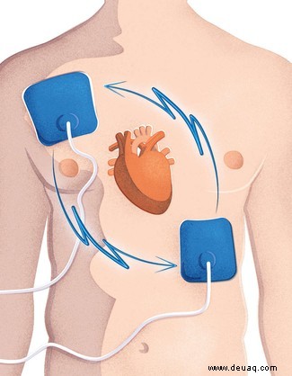 Wie funktioniert ein Defibrillator? 
