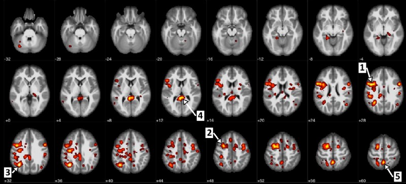 KI wird jetzt verwendet, um Anzeichen von Schizophrenie in Gehirnscans zu erkennen 