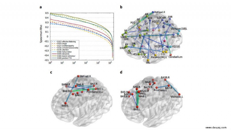 KI wird jetzt verwendet, um Anzeichen von Schizophrenie in Gehirnscans zu erkennen 