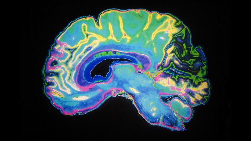 Diese KI kann die Alzheimer-Krankheit sechs Jahre vor Ärzten erkennen